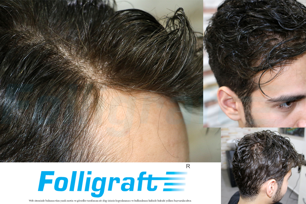 folligrafti kimler kullanabilir