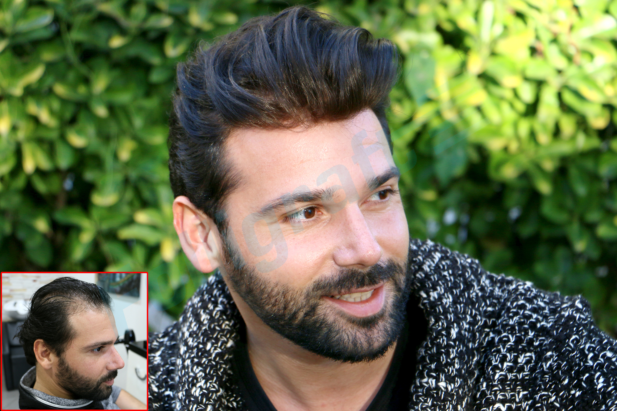 folligraft, protezsaç, saç protezi, nova hair