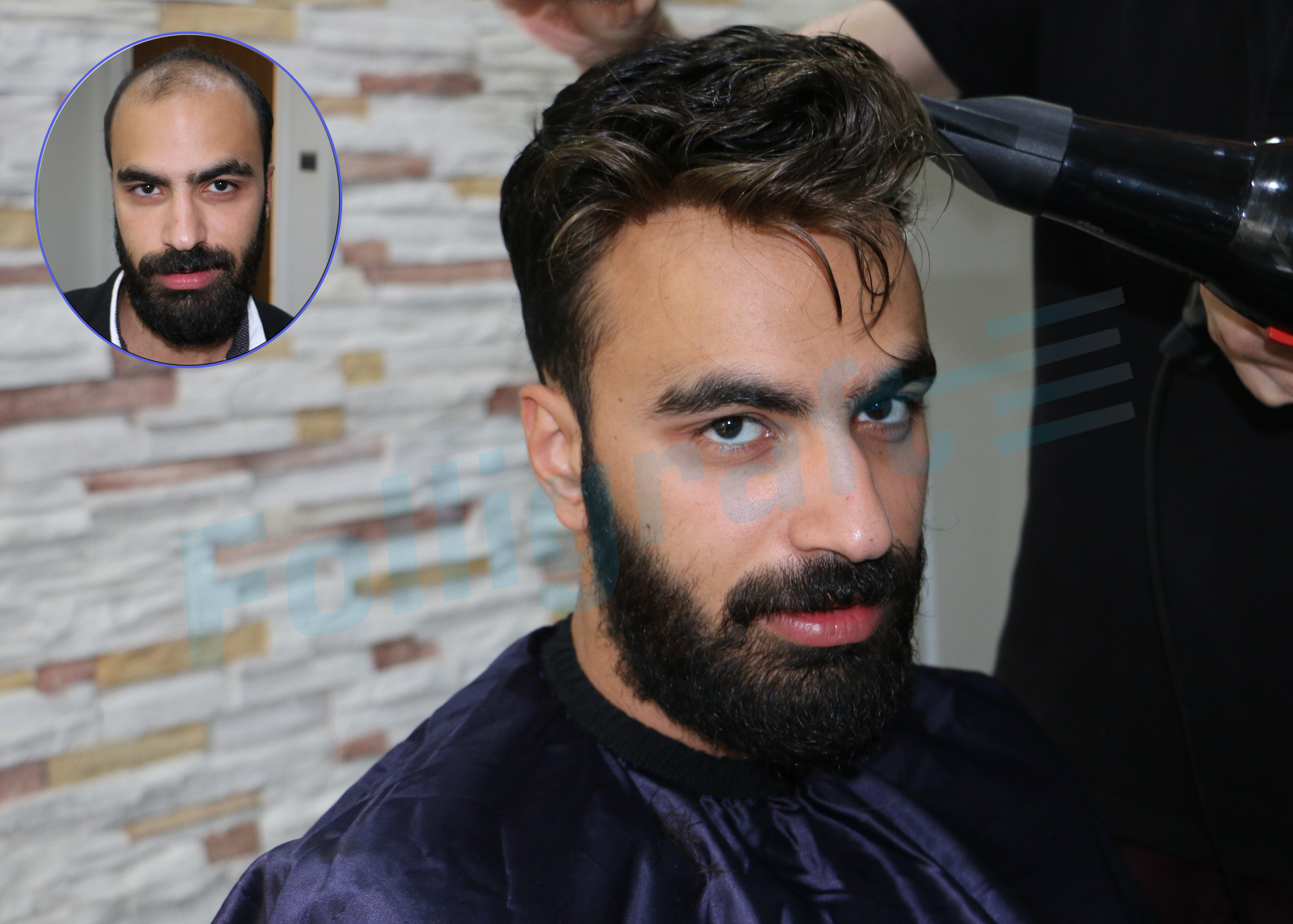 neden folligraft, folligraft nedir, protez saç, nova hair, folligraft